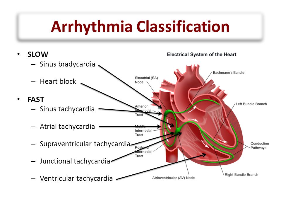 Arrhythmia Classification