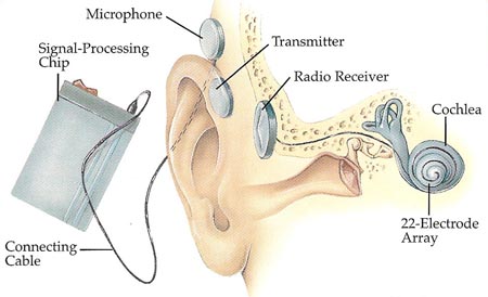 Cochlear Implant - Diagram