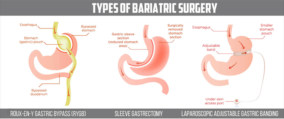 types-of-bariatric-surgery