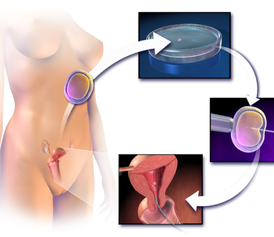 IVF - Assisted Reproductive Technology