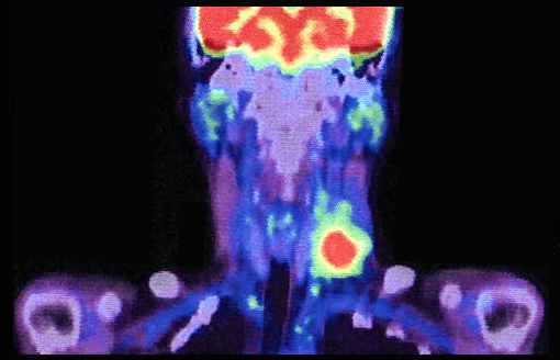 PET-CT Scanning of Lymph Node metastases in Cancer