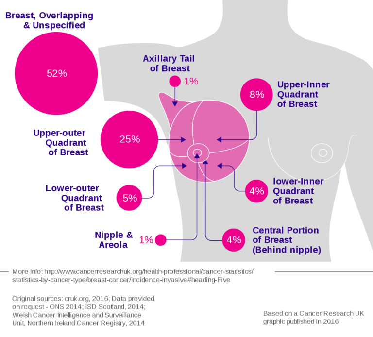 Breast Cancer - Wikipedia