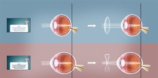 Sixty per cent metropolitan male between 7 to 35 age group are at higher risk of Refractive Error Disorder Refractive Error Disorder