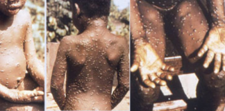 The clinical presentation of monkeypox by Wikipedia