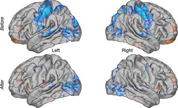 : Anterior thalamocortical functional connectivity changes before and after Yoga Nidra meditation in expert meditators.