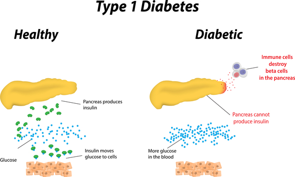 Type-1 diabetes pathophysiology