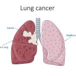 Lung cancer (Image by Wikipedia)