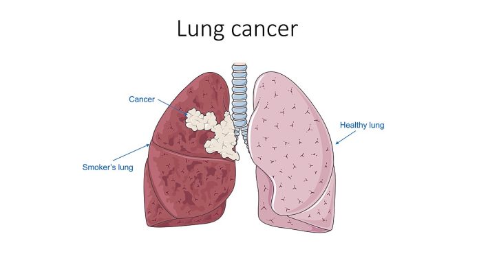 Lung cancer (Image by Wikipedia)